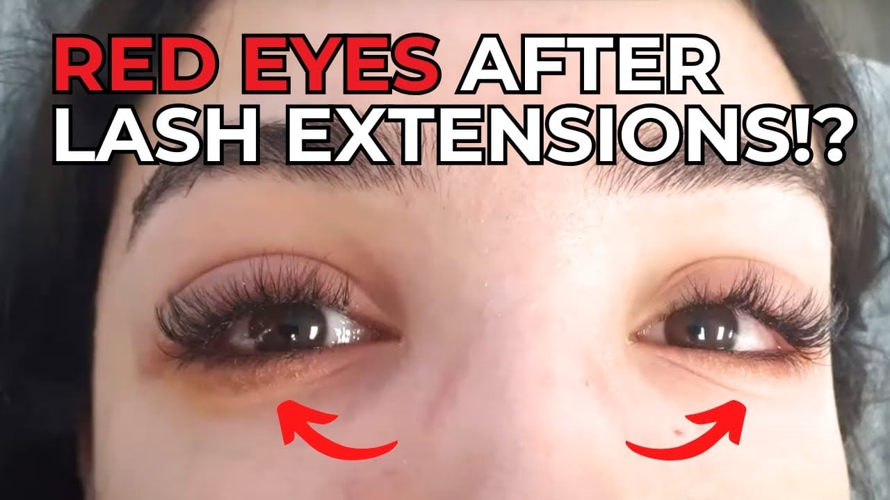 Red Eyes After Eyelash Extensions – How to Treat & Prevent